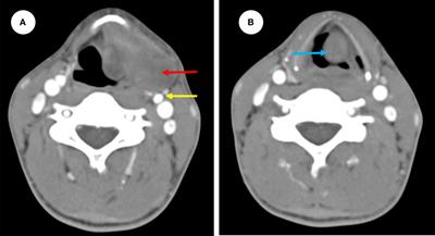 Laryngeal extra-skeletal Ewing sarcoma treated with DC-CTL immunotherapy: A case report and review of the literature